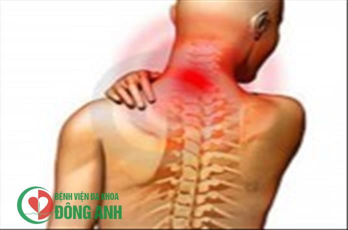 BẠN CÓ BIẾT THOÁI HÓA ĐỐT SỐNG CỔ CÓ THỂ GÂY BẠI LIỆT?