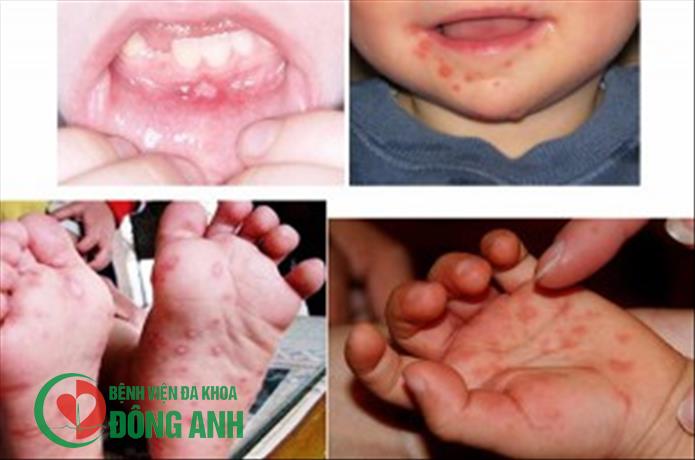Cách chăm sóc bệnh nhi bị bệnh Tay - Chân - Miệng