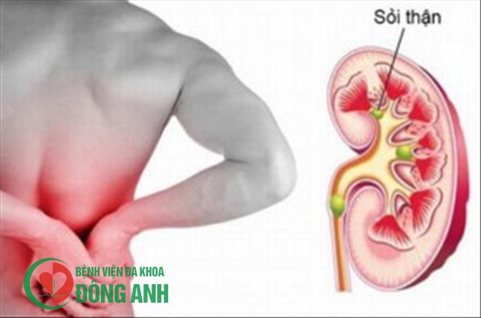 Biến chứng nguy hiểm từ sỏi thận lâu năm