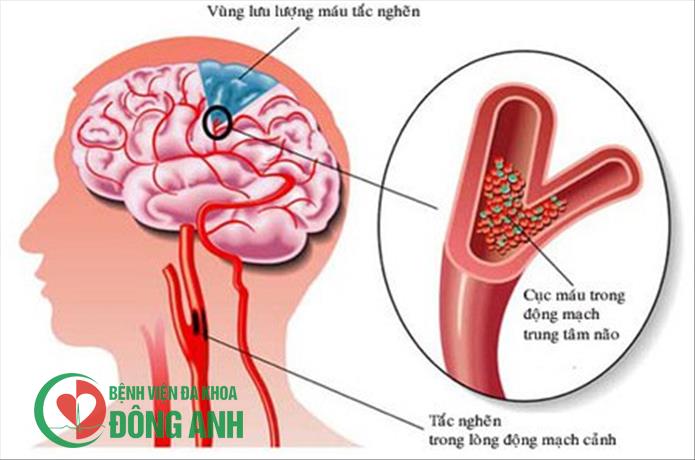Đột quỵ: Nguyên nhân, dấu hiệu nhận biết, cách phòng tránh