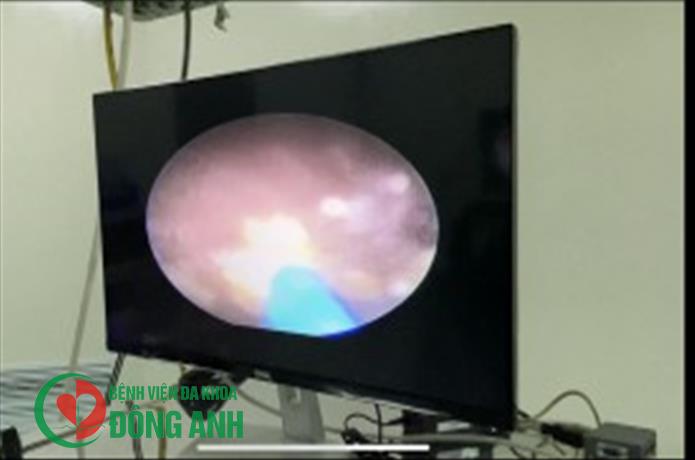 CHẨN ĐOÁN VÀ ĐIỀU TRỊ SỎI THẬN BẰNG PHẪU THUẬT NỘI SOI NIỆU QUẢN NGƯỢC DÒNG TÁN SỎI LASER VỚI SOI ỐNG MỀM