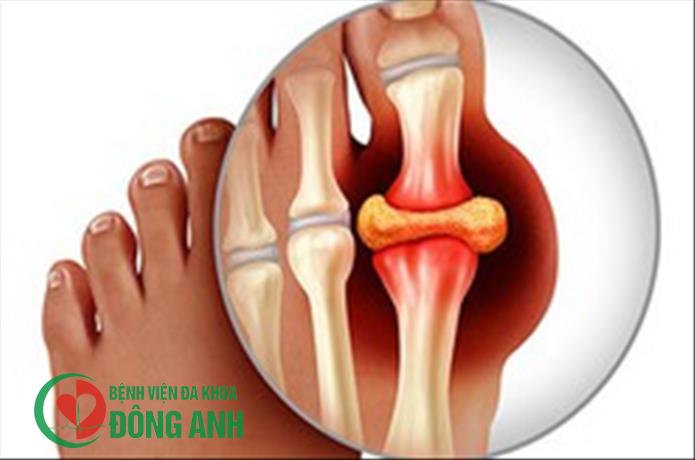 Nhận biết các tác nhân phổ biến gây ra cơn đau bùng phát dữ dội với người bệnh gout