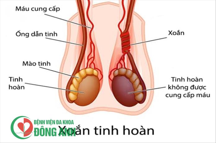 CẢNH BÁO ĐIỀU ĐÁNG TIẾC KHI THĂM KHÁM XOẮN TINH HOÀN Ở GIAI ĐOẠN MUỘN