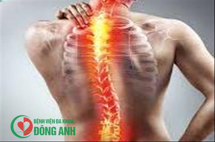 Đau lưng do thoát vị đĩa đệm, cần hạn chế ăn gì để phòng tránh cơn đau?