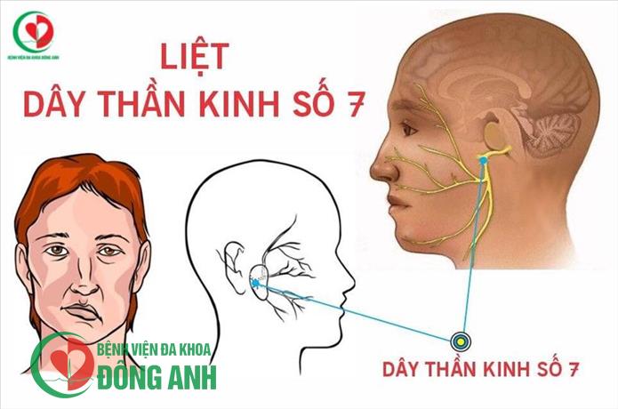 PHÒNG TRÁNH LIỆT DÂY THẦN KINH SỐ 7 DO NẰM ĐIỀU HÒA QUÁ LẠNH