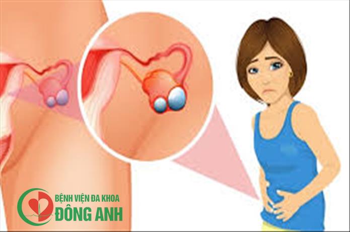 CẢNH BÁO KHỐI U BUỒNG TRỨNG Ở TRẺ EM