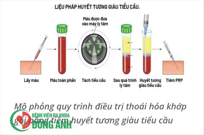TIÊM PRP- GIẢI PHÁP TỐI ƯU ĐIỀU TRỊ BỆNH LÝ XƯƠNG KHỚP TẠI BỆNH VIỆN ĐA KHOA ĐÔNG ANH