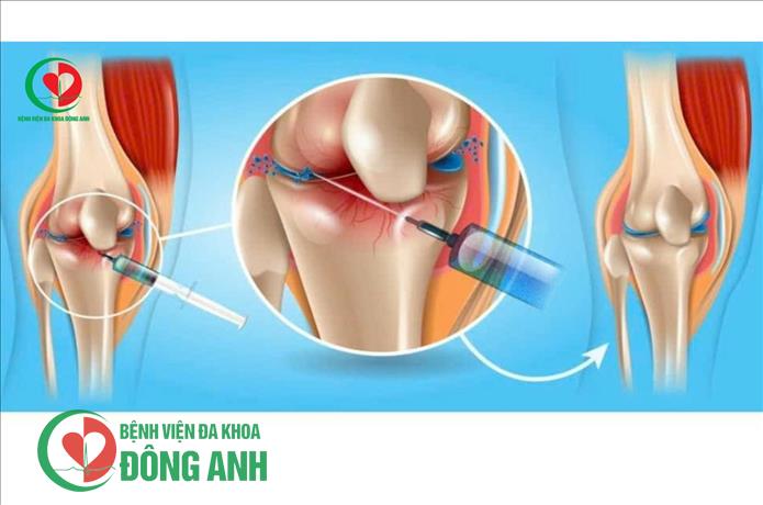 NHỮNG ƯU ĐIỂM CỦA PHƯƠNG PHÁP TIÊM PRP TRONG ĐIỀU TRỊ BỆNH LÝ XƯƠNG KHỚP TẠI BỆNH VIỆN ĐA KHOA ĐÔNG ANH