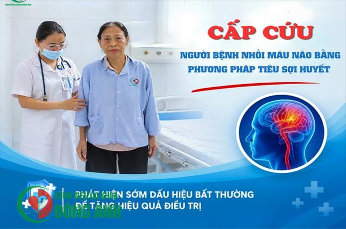 BỆNH VIỆN ĐA KHOA ĐÔNG ANH CẤP CỨU THÀNH CÔNG NGƯỜI BỆNH NHỒI MÁU NÃO BẰNG PHƯƠNG PHÁP TIÊU SỢI HUYẾT